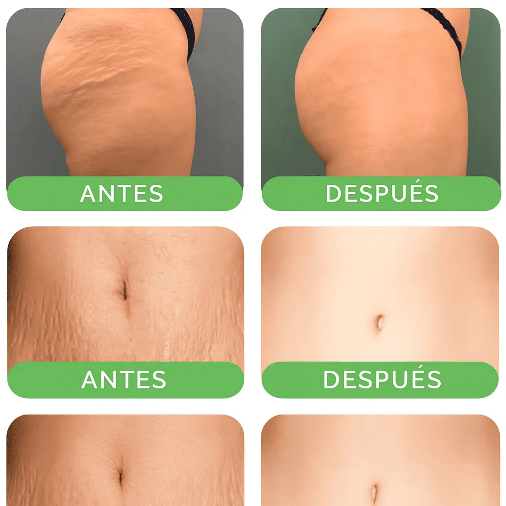 CREMA ANTIESTRÍAS SKINREPAIR